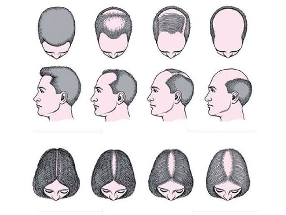 Androgenetikus alopecia férfiaknál és nőknél