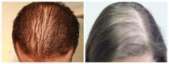 Diffúz alopecia