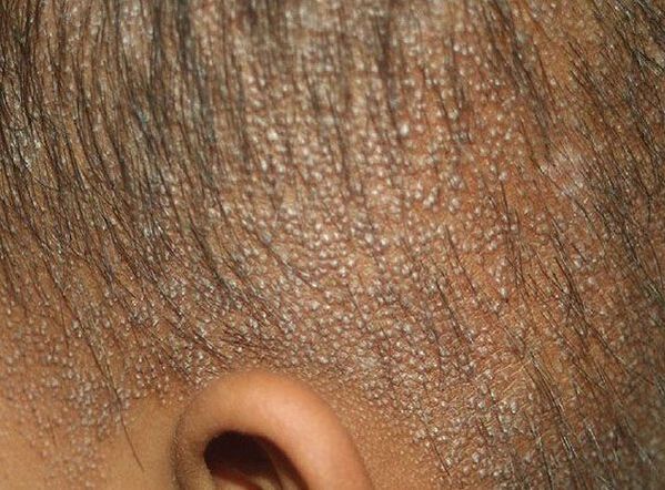 Follikuláris mucinosis
