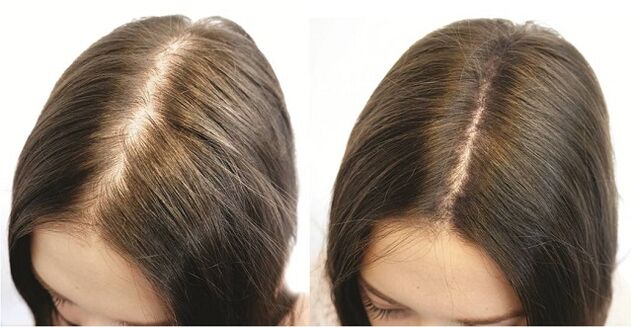 A nők alopecia időben történő kezelésének eredménye