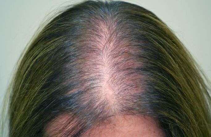 Alopecia (kopaszság) nőknél