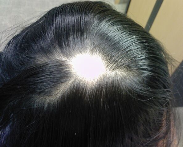 Alopecia areata vagy alopecia areata nőknél