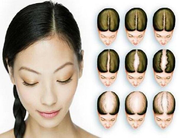 Az alopecia szakaszai nőknél