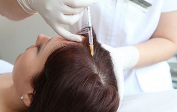 Mezoterápia a női alopecia kezelésében