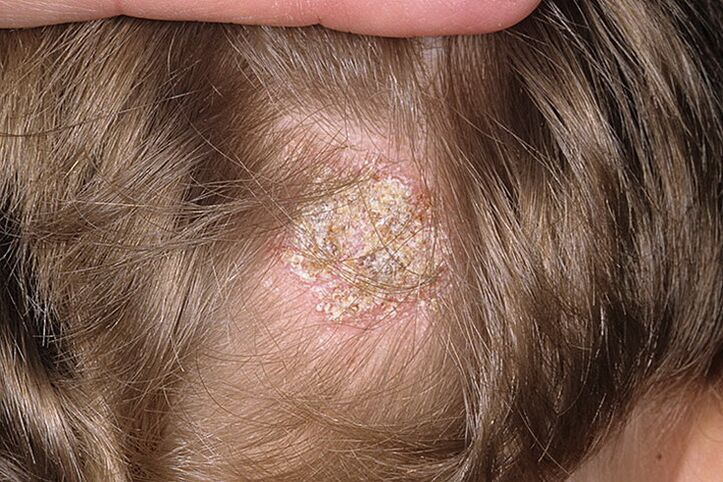 Seborrheás típusú alopecia nőknél