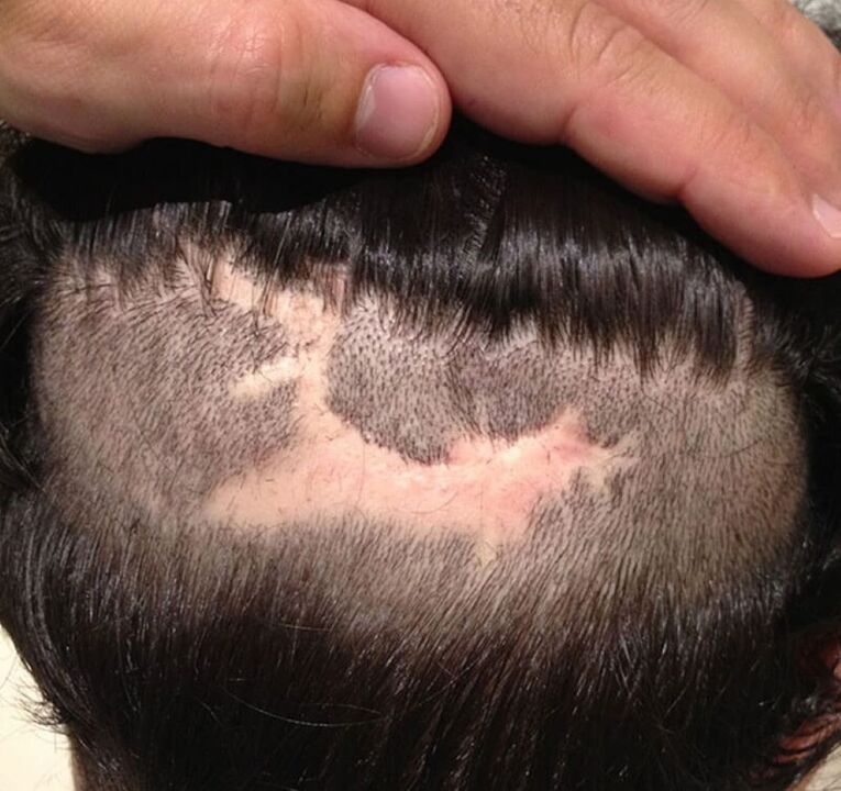 a fejbőr cicatricial alopecia