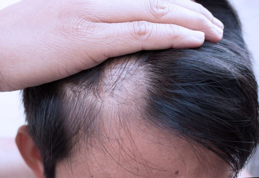 diffúz alopecia a fejben