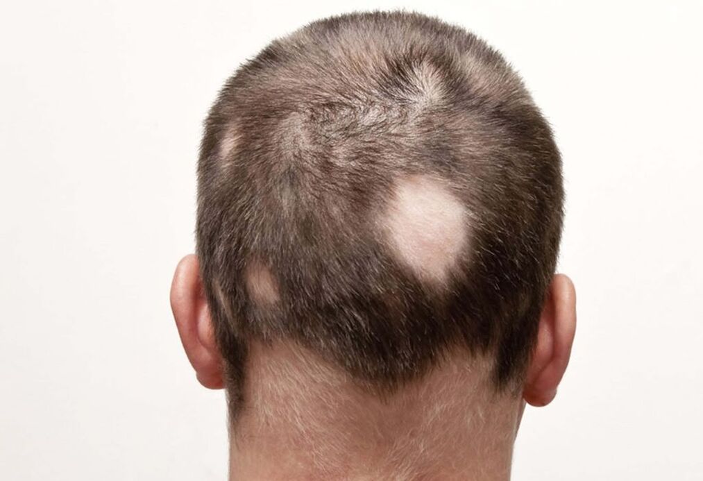 fészkelő (gócos) alopecia a fejben