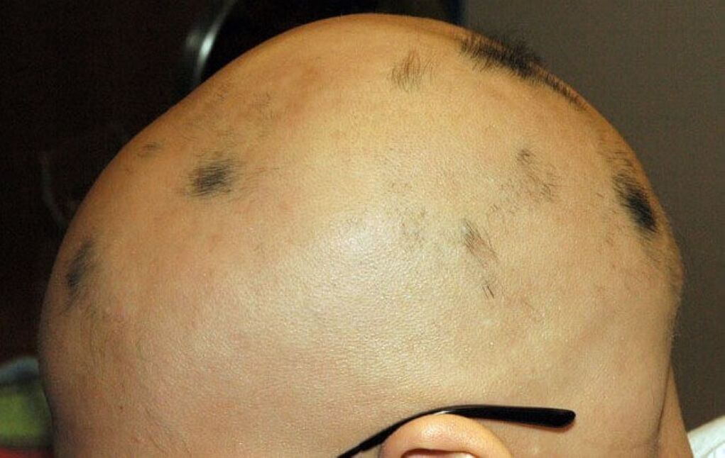 teljes fejbőr alopecia egy férfiban
