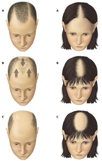 Androgén alopecia férfiaknál és nőknél