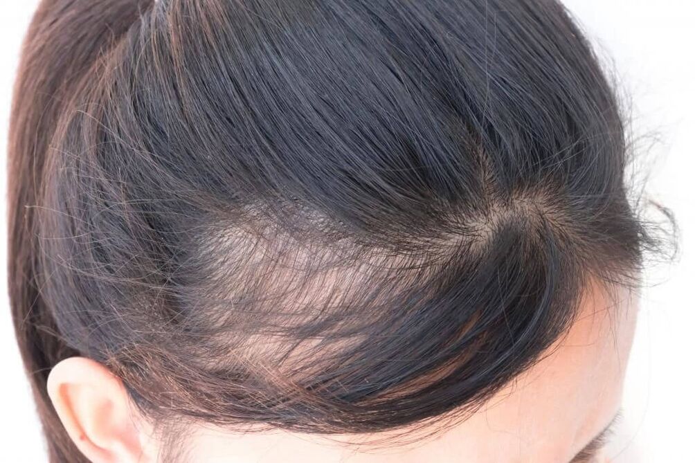 Androgén alopecia nőknél