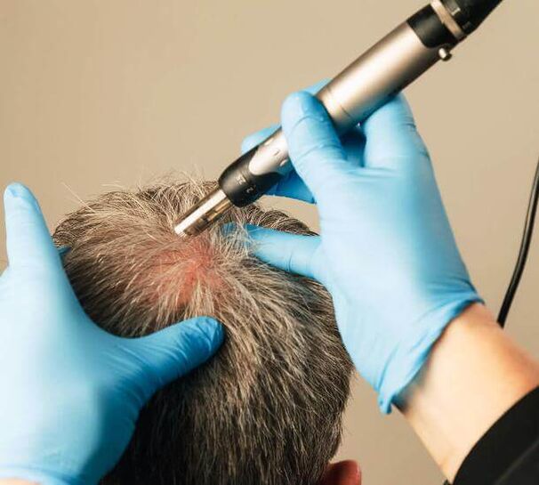 Fizioterápia androgén alopecia kezelésére