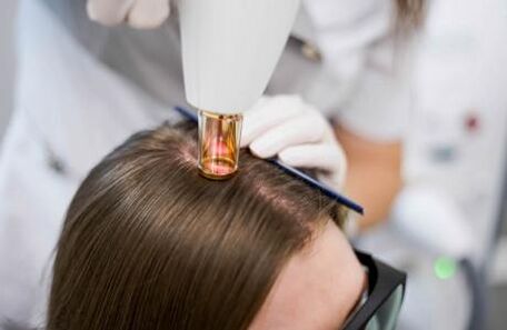 Lézerterápia androgén alopecia kezelésére