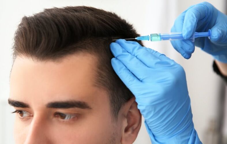 Mezoterápia a haj növekedésének serkentésére androgén alopecia esetén